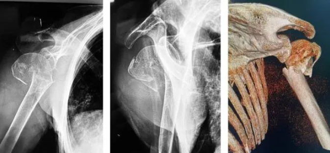 身披十余公斤「战甲」,医生在 X 光下为畸形老人完成高难度接骨术