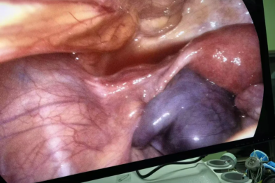 30 岁女子突发腹痛险失卵巢，多学科团队紧急手术化险为夷