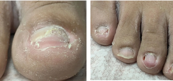 灰指甲、甲沟炎别硬扛！正兴医院科学治疗守护指甲健康！