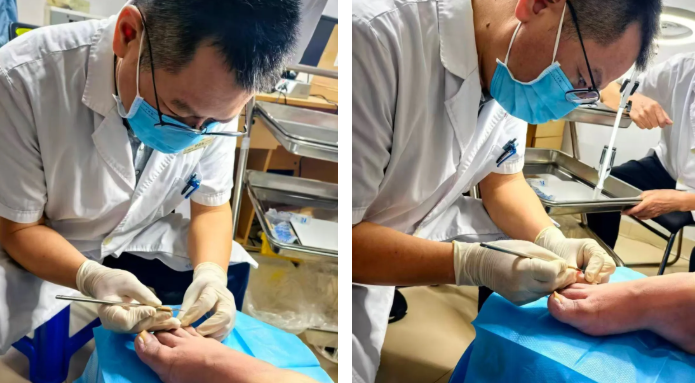 灰指甲、甲沟炎别硬扛！正兴医院科学治疗守护指甲健康！