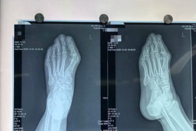 大脚趾外翻 20 多年，疼得走不了路！这种畸形别硬扛，浙大四院手足外科开展第四代拇外翻微创手术