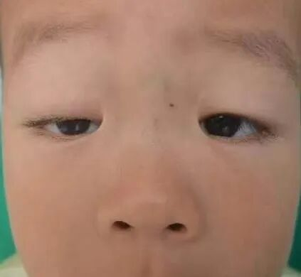 孩子有上睑下垂该怎么治疗?武汉普瑞眼科李强科普手术矫正方式