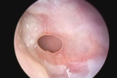 关一扇门，开一扇窗——聊聊中耳炎的那些事儿