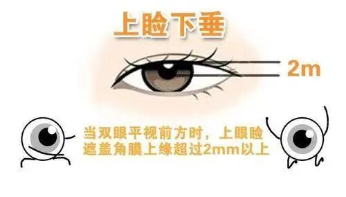 孩子有上睑下垂该怎么治疗?武汉普瑞眼科李强科普手术矫正方式