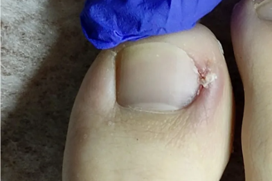 灰指甲、甲沟炎别硬扛！正兴医院科学治疗守护指甲健康！