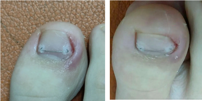 灰指甲、甲沟炎别硬扛！正兴医院科学治疗守护指甲健康！