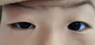 孩子有上睑下垂该怎么治疗?武汉普瑞眼科李强科普手术矫正方式