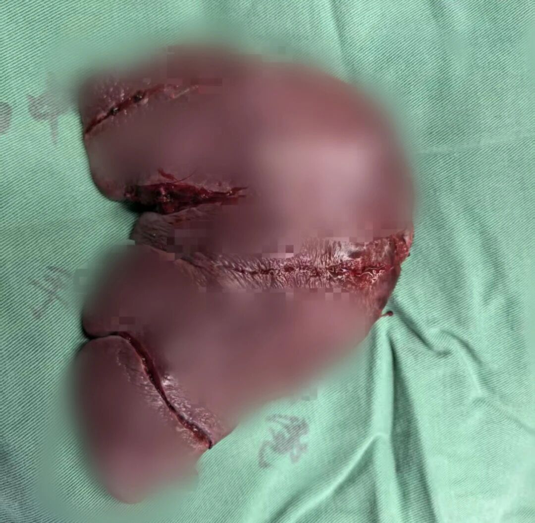 【聚焦临床前沿 167】外卖小哥摔一跤竟腹腔「血崩」!——脾脏脆如 「豆腐」,幸好「搬家+回血」抢回生命