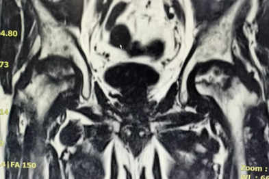 全髋关节置换让股骨头坏死患者重获新生