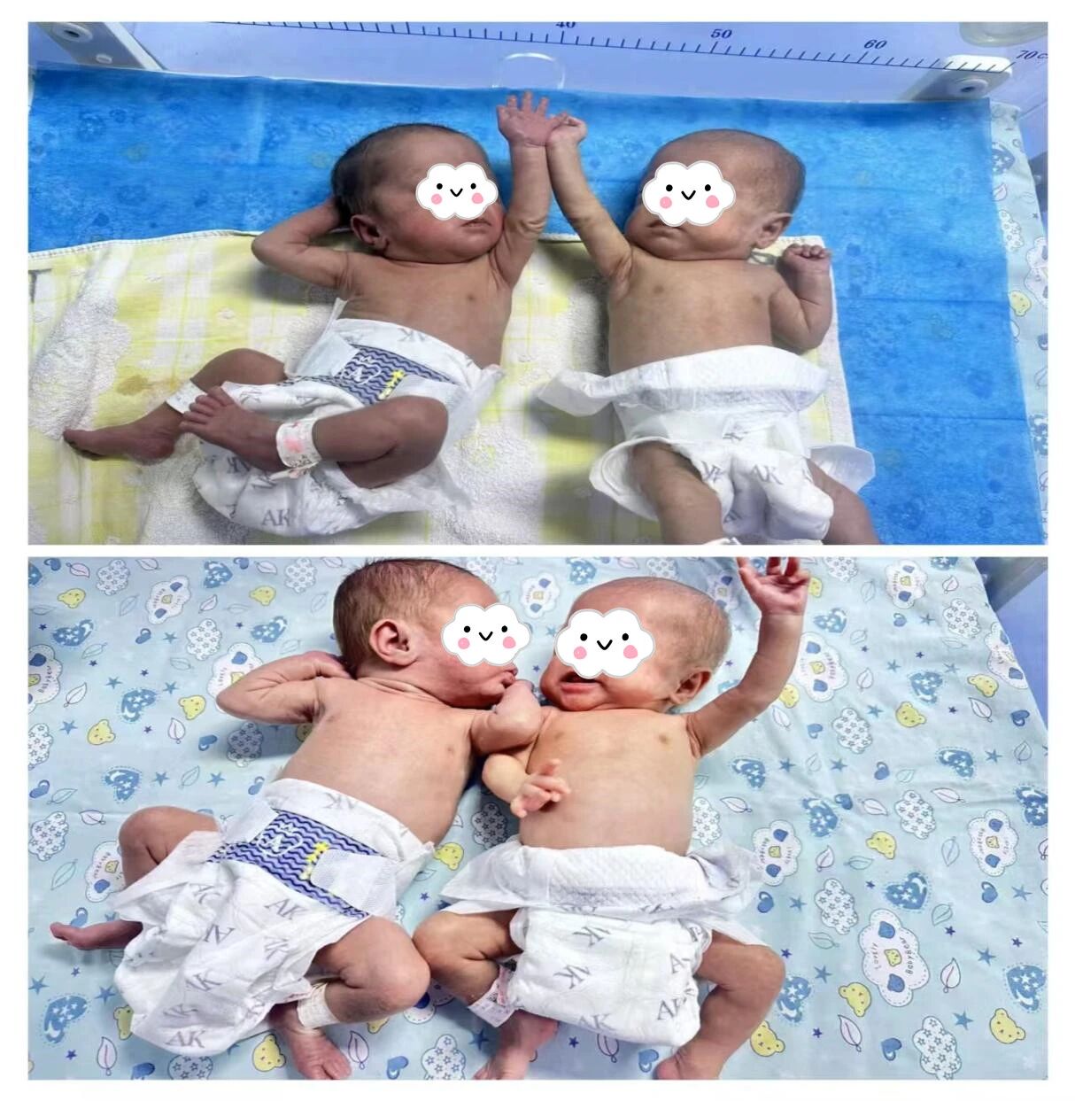 援疆动态丨「掌心公主」勇闯人生第一关!粤喀携手挽救两名超早产女婴!