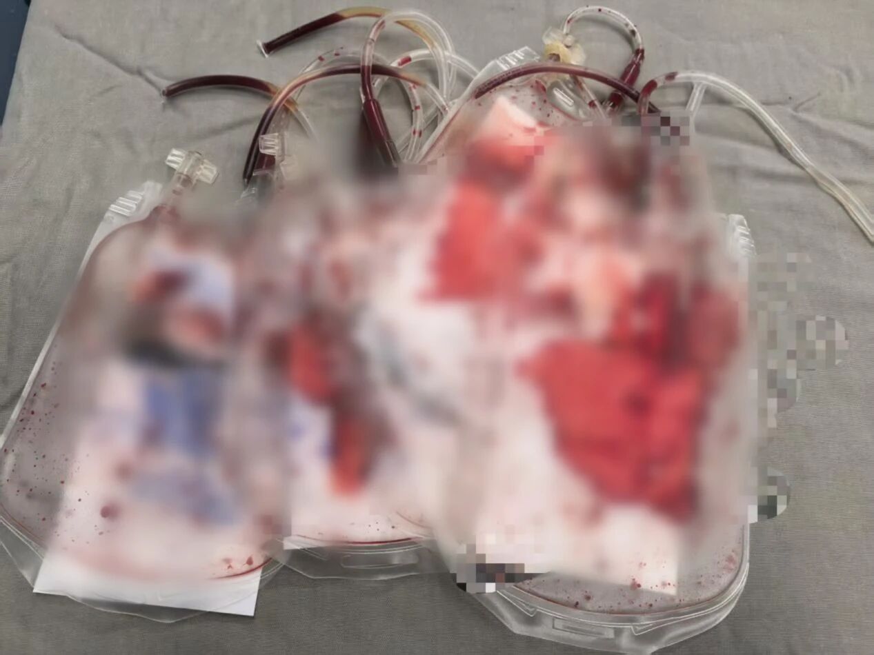 【聚焦临床前沿 167】外卖小哥摔一跤竟腹腔「血崩」!——脾脏脆如 「豆腐」,幸好「搬家+回血」抢回生命