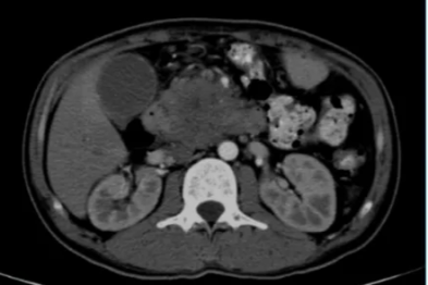 37 岁青年胰腺癌绝境重生，纳米刀技术点燃生命希望