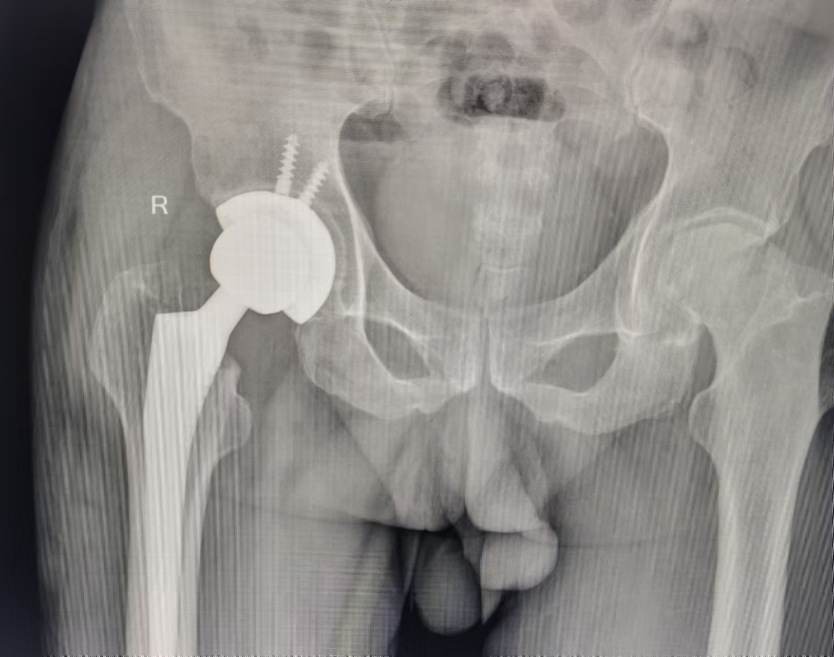 全髋关节置换让股骨头坏死患者重获新生