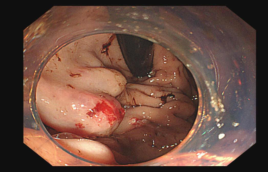 胃底的「小喷泉」止住了