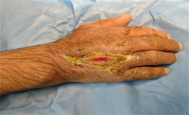 一道小擦伤，为何险些截肢？——糖尿病患者必须警惕的伤口管理