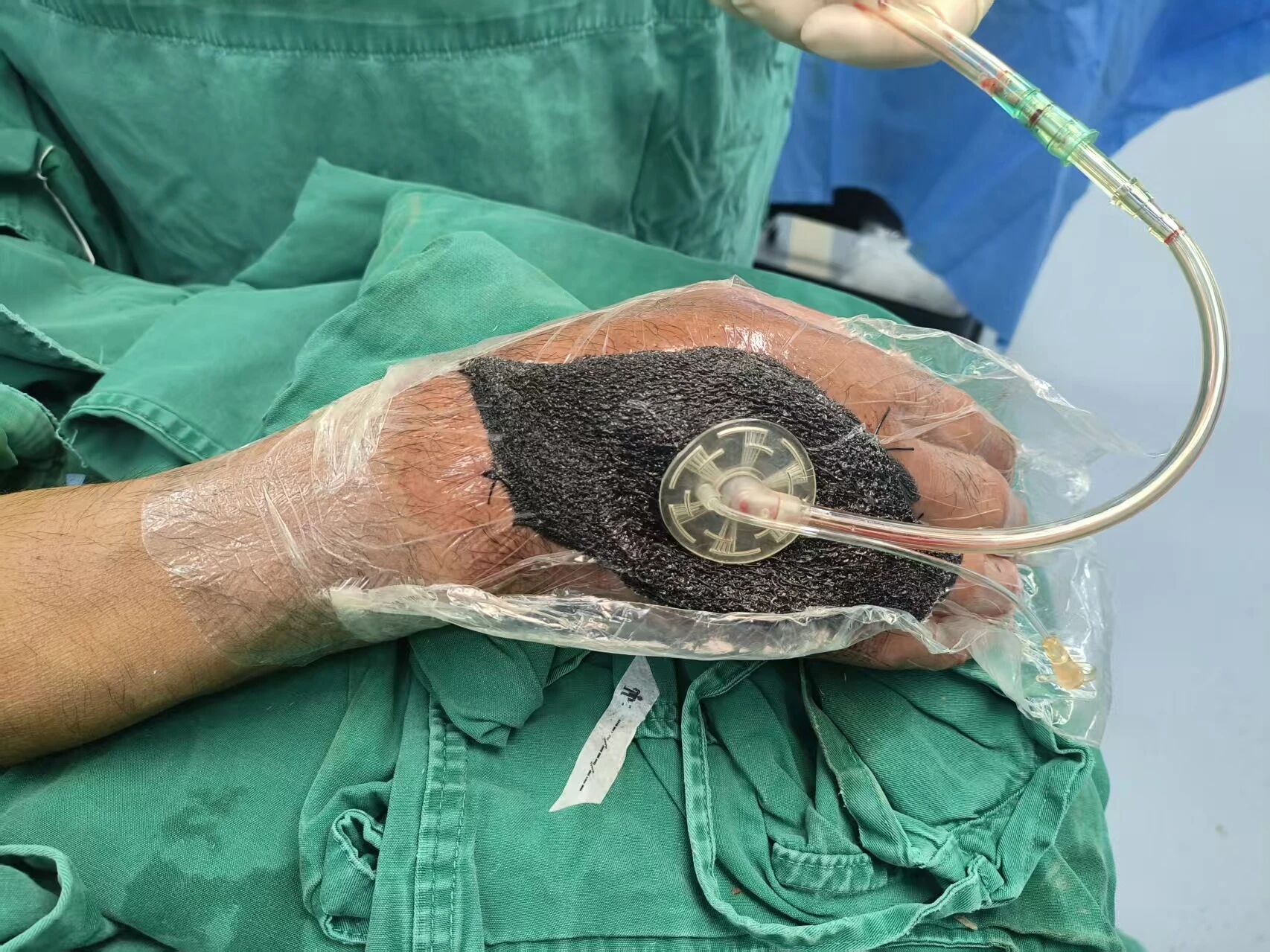 一道小擦伤，为何险些截肢？——糖尿病患者必须警惕的伤口管理