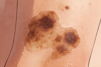 咖啡斑≠普通胎记，这些知识要牢记！