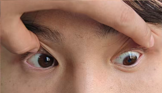 足球运动员手术矫正歪头视物 武汉普瑞眼科林珊提醒重视成人斜视