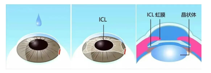 当眼睛「空间有限」遇上超高度近视:一例小角膜合并浅前房的 ICL 手术案例