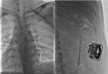 南大二附院成功应用脊髓电刺激术救治一例顽固性糖尿病胃轻瘫患者——多学科联手「电」亮生命之路