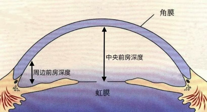 当眼睛「空间有限」遇上超高度近视:一例小角膜合并浅前房的 ICL 手术案例