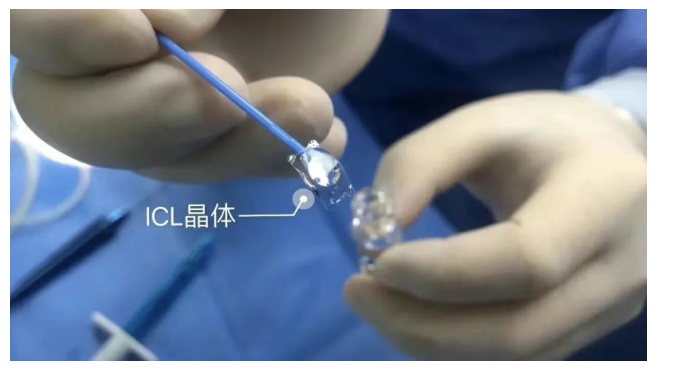 当眼睛「空间有限」遇上超高度近视:一例小角膜合并浅前房的 ICL 手术案例