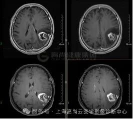 【高尚病例】高级别胶质瘤