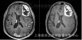 【高尚病例】高级别胶质瘤