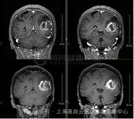 【高尚病例】高级别胶质瘤
