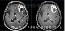 【高尚病例】高级别胶质瘤
