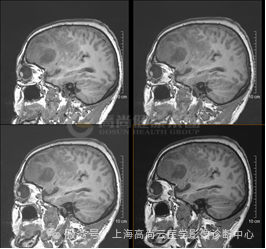 【高尚病例】高级别胶质瘤
