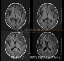 【高尚病例】高级别胶质瘤