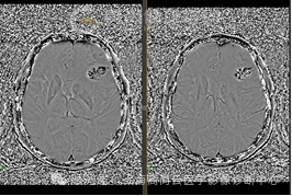 【高尚病例】高级别胶质瘤