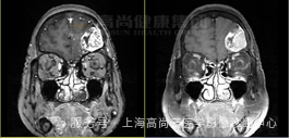 【高尚病例】高级别胶质瘤