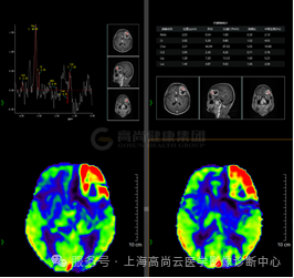 【高尚病例】高级别胶质瘤