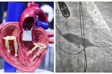 为重度主动脉瓣狭窄患者完成微创 「换心门」！ 镇江瑞康医院成功开展 TAVI 术
