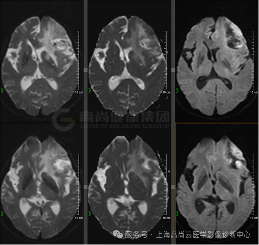 【高尚病例】高级别胶质瘤
