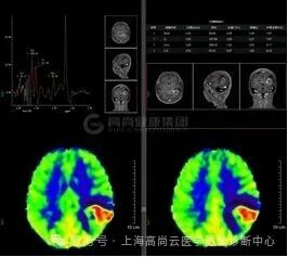 【高尚病例】高级别胶质瘤