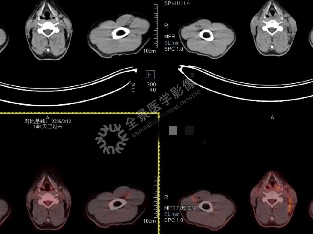 淋巴瘤治疗显成效!PET/CT 见证病灶「大撤退」