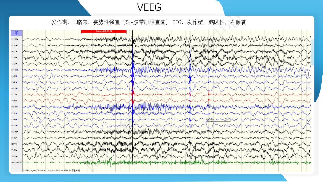 《「痫停」信步》癫痫治疗病例荟萃第四十二期---手术治疗孤立性皮层发育不良为表现的结节性硬化一例