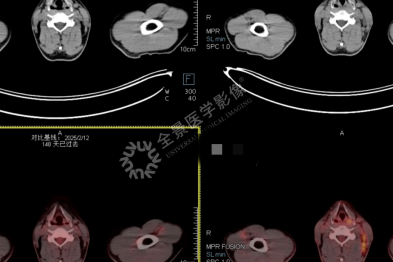 淋巴瘤治疗显成效！PET/CT 见证病灶 「大撤退」