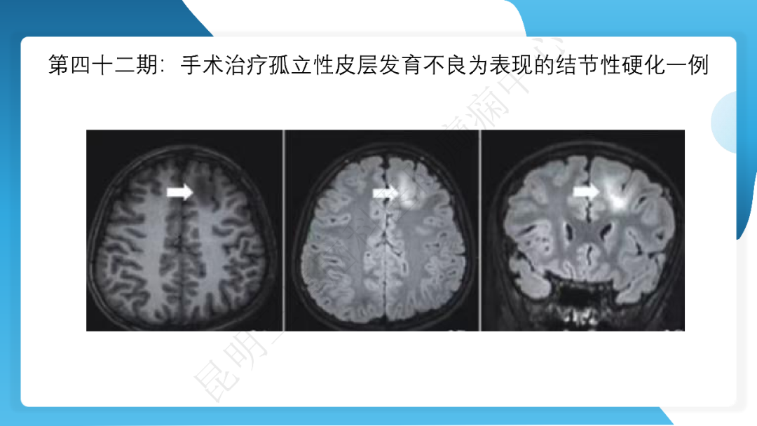 《「痫停」信步》癫痫治疗病例荟萃第四十二期---手术治疗孤立性皮层发育不良为表现的结节性硬化一例