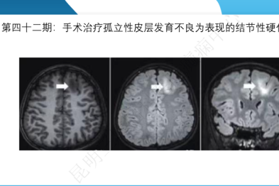 《「痫停」信步》癫痫治疗病例荟萃第四十二期---手术治疗孤立性皮层发育不良为表现的结节性硬化一例