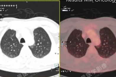 体检发现肺多发微小结节怎么办？