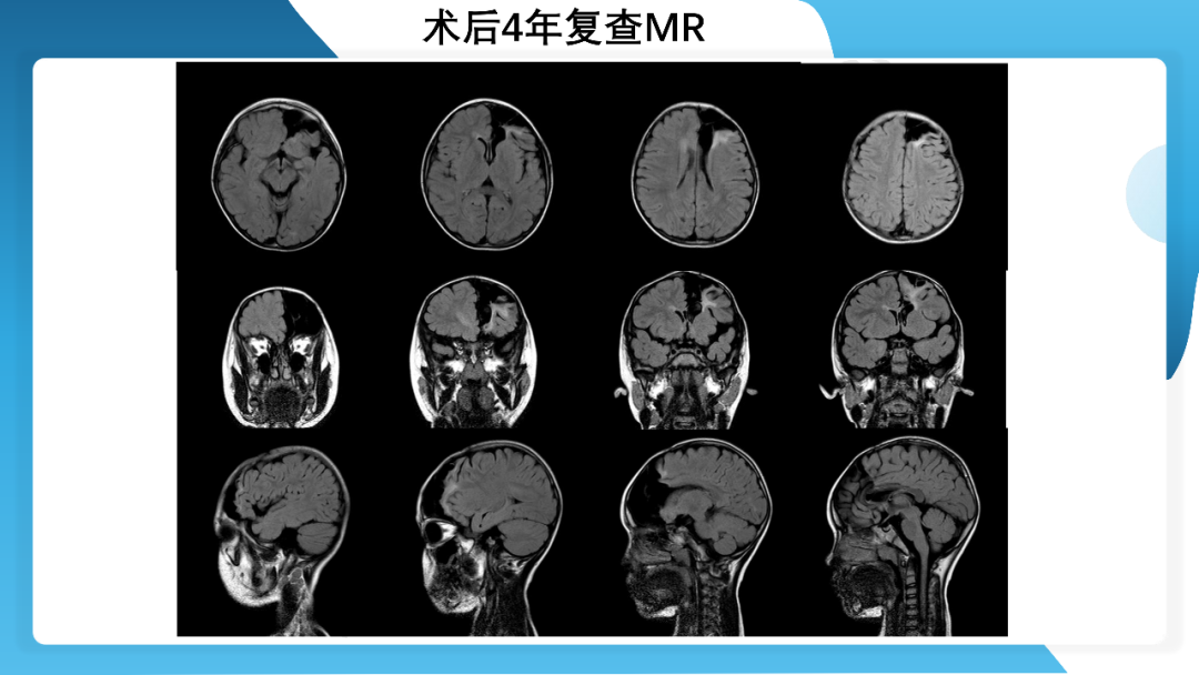 《「痫停」信步》癫痫治疗病例荟萃第四十二期---手术治疗孤立性皮层发育不良为表现的结节性硬化一例