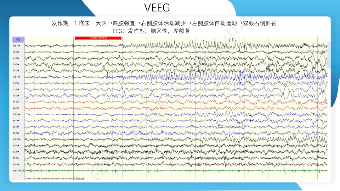 《「痫停」信步》癫痫治疗病例荟萃第四十二期---手术治疗孤立性皮层发育不良为表现的结节性硬化一例