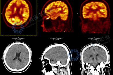 持续 6 年的「眩晕症」，遍查无果后终于找到了答案