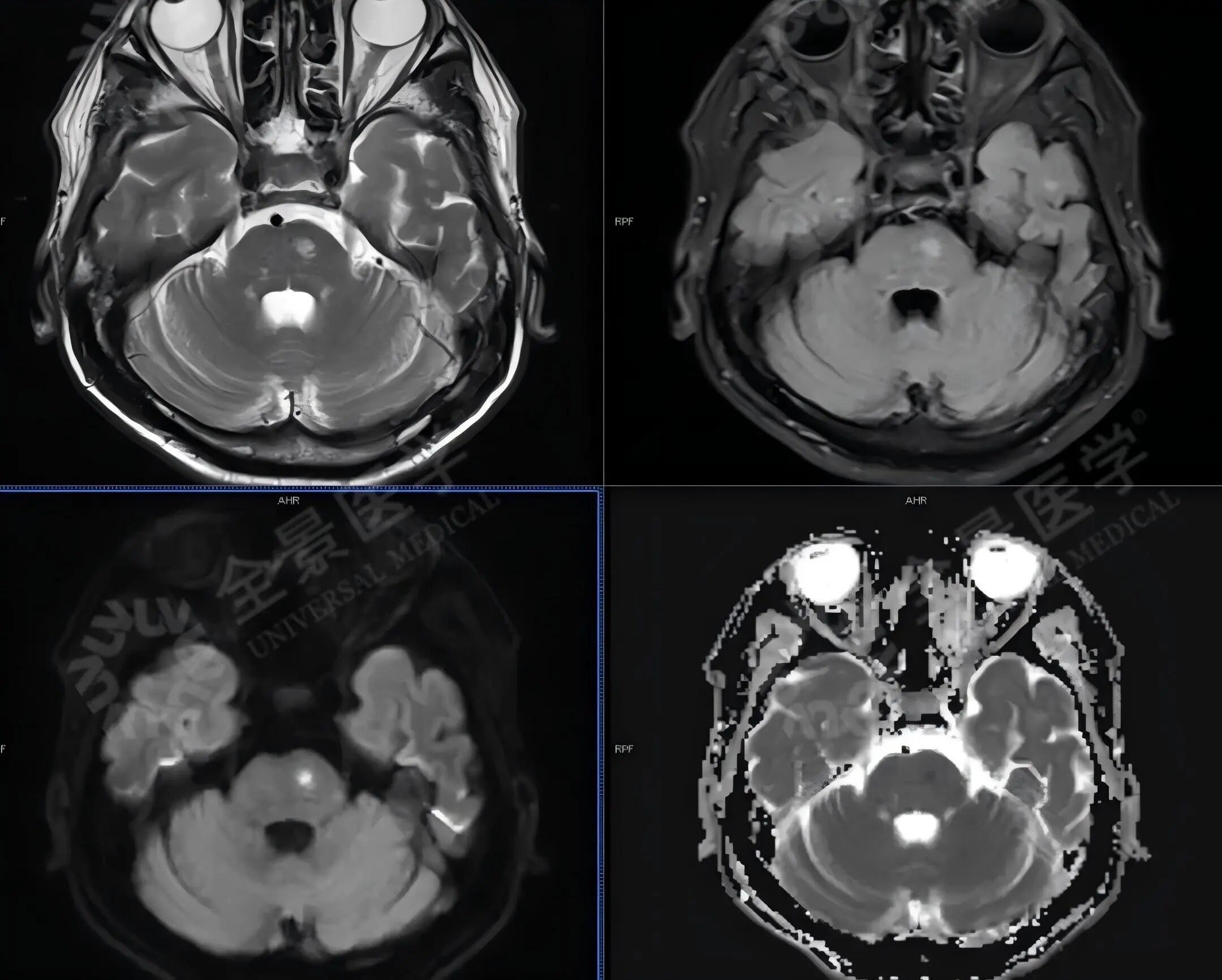 体检必看：比查肿瘤更易忽视的脑血管风险！