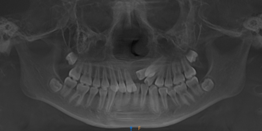 乳牙脱数年恒牙「失踪」?原是埋伏牙颌骨「捉迷藏