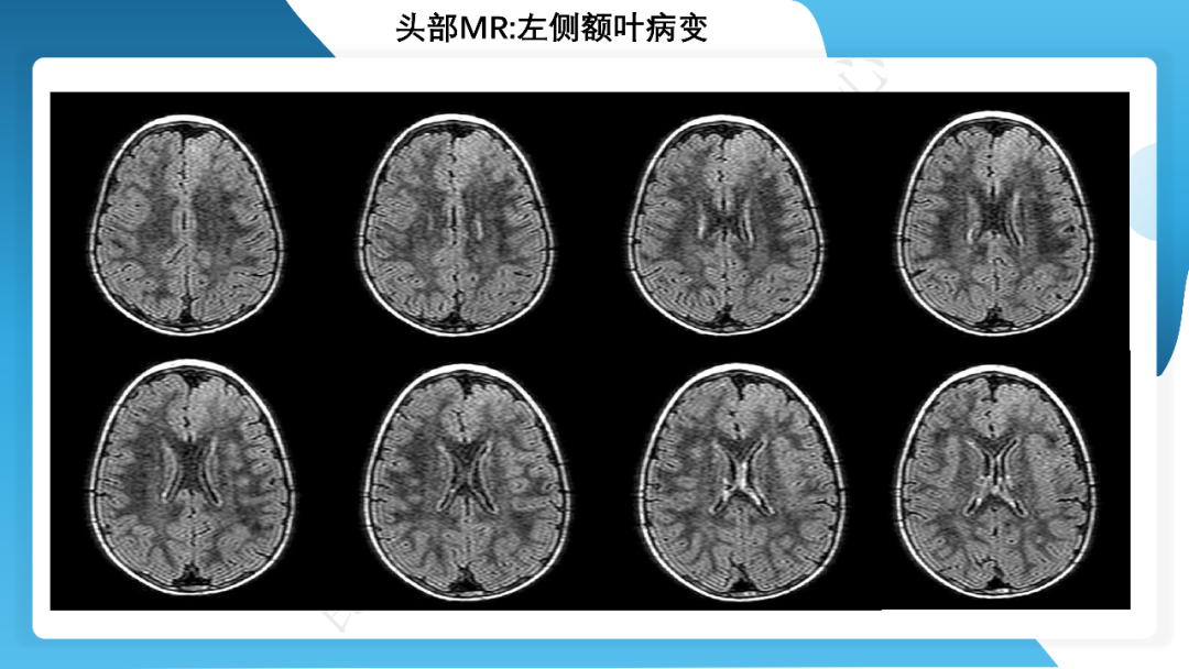 《「痫停」信步》癫痫治疗病例荟萃第四十二期---手术治疗孤立性皮层发育不良为表现的结节性硬化一例